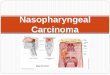 Nasopharyngeal Carcinoma - ENT Lectures