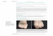A Case of Polymetatarsia Without Polydactyly