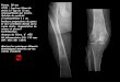 ATCD : fracture fémorale âge de 12 ans, ostéosynthésée par 