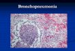 Bronchopneumonia NOT TO BE REPRODUCED