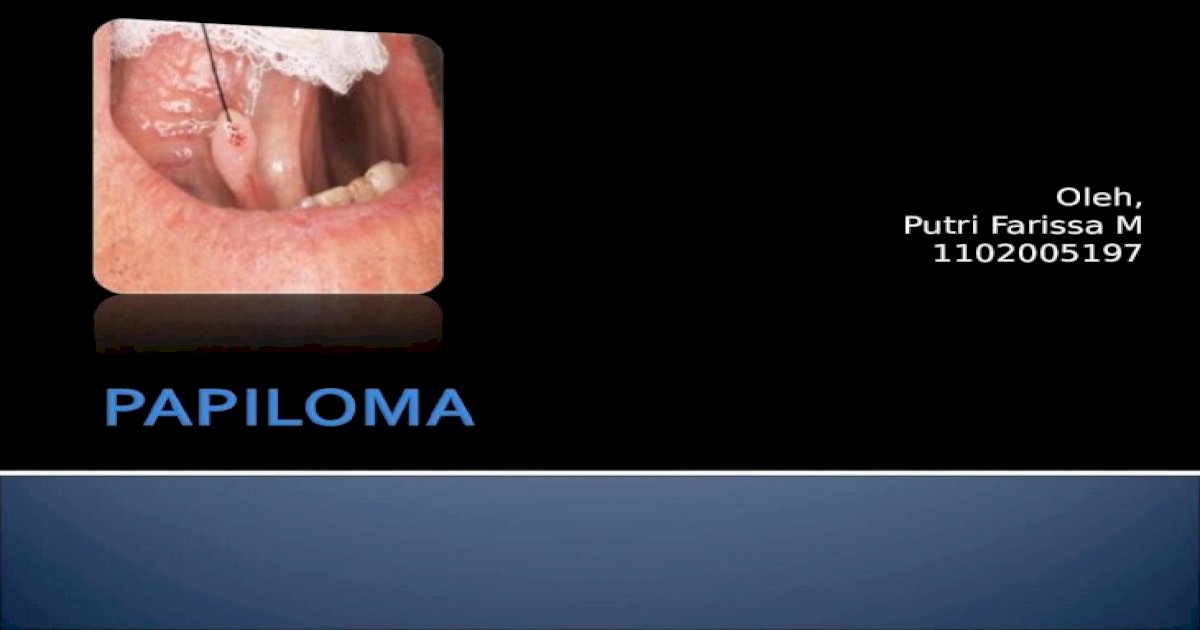 Papiloma rongga mulut adalah. Cancer genetic alteration
